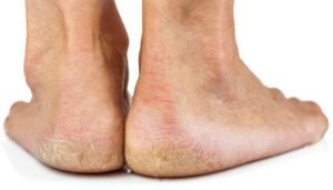 Causes of dry cracked heels