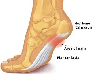 Heel pain causes