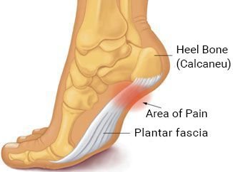 how to use spiky massage ball for plantar fasciitis