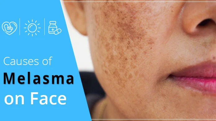 Causes of melasma on face